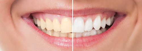 Teeth-Whitening-Treatments